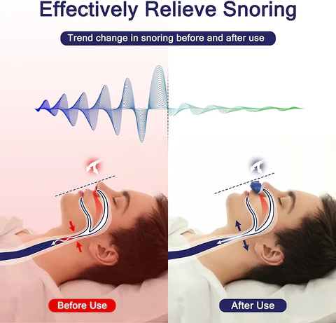 Mini Anti-Snoring Device in Medical Silicone for Travel